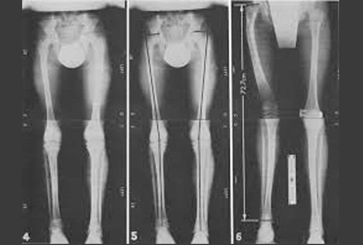 Scanogram ( Pelvis to Ankle Digital X- Ray )
