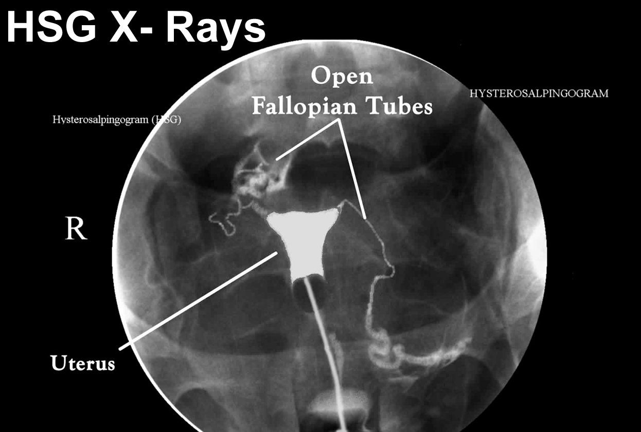 HSG X- Rays