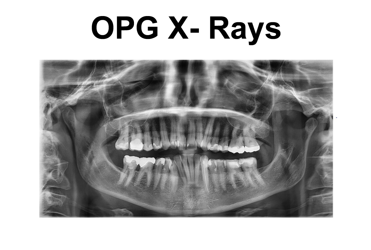 OPG X- Rays