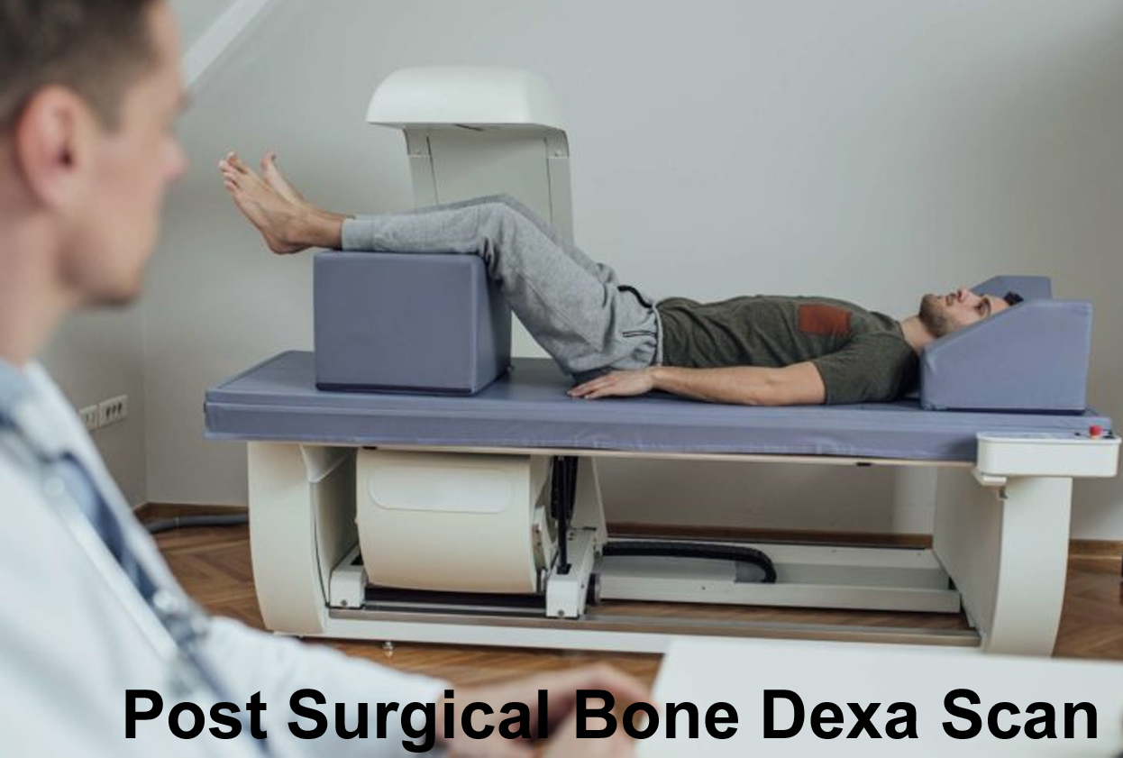 Post Knee Replacement; Post Operative Spine Surgeries Bone Dexa Scans
