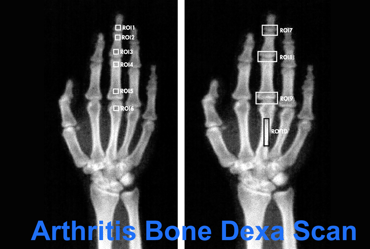 Arthritis Bone Dexa Scan