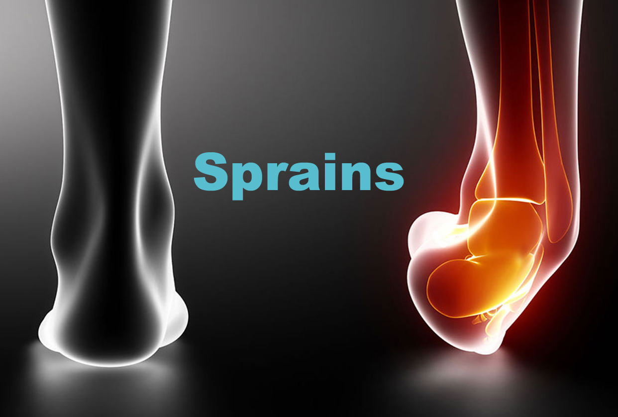 Sprains