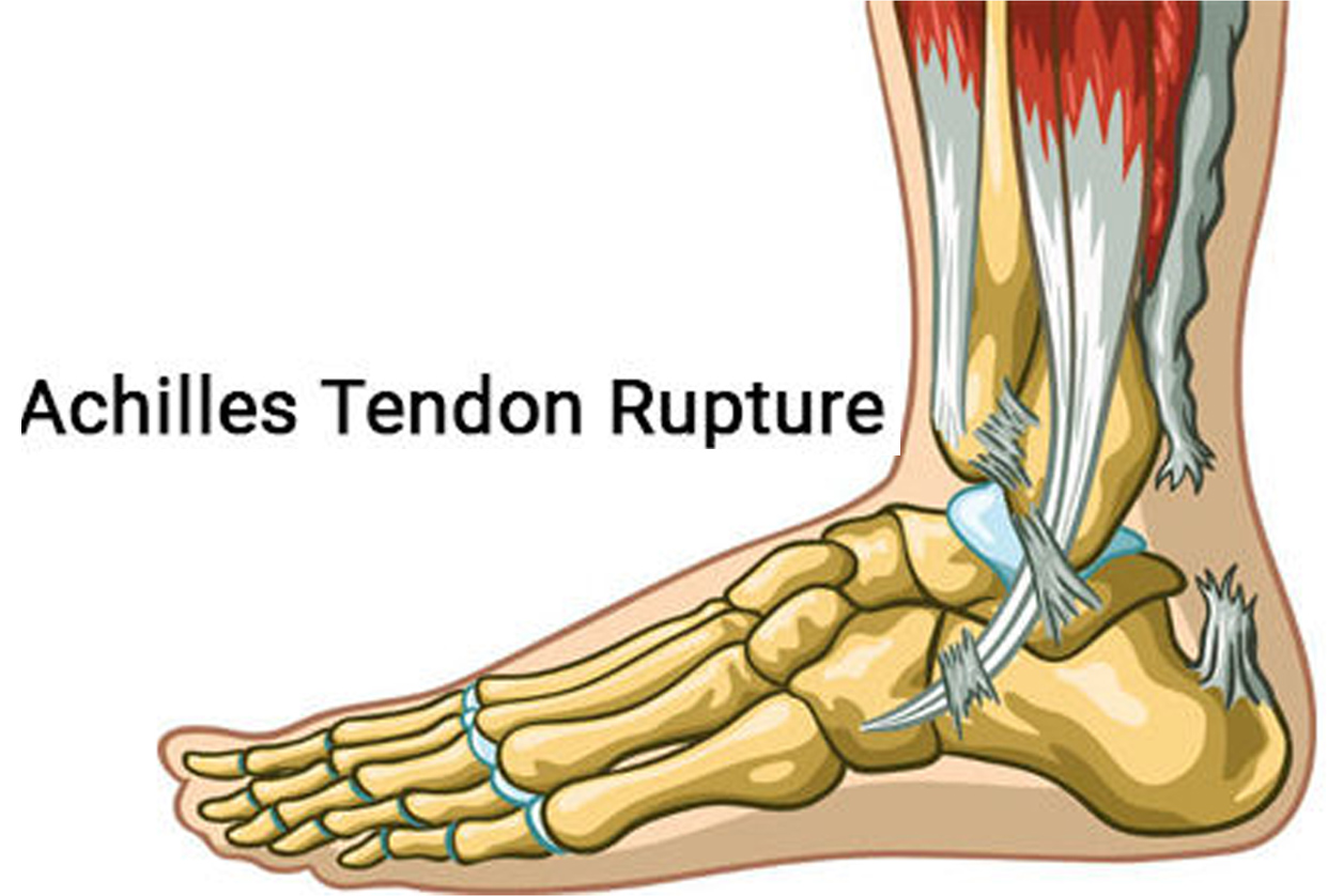 Achilles tendon rupture